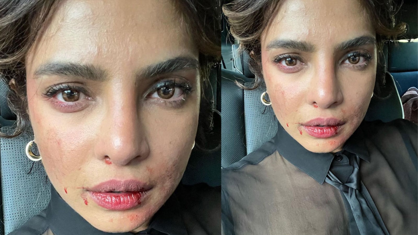 Priyanka Chopra shares pic of bruised face from sets of Citadel, fans ask ‘What happened are you ok’. See pic