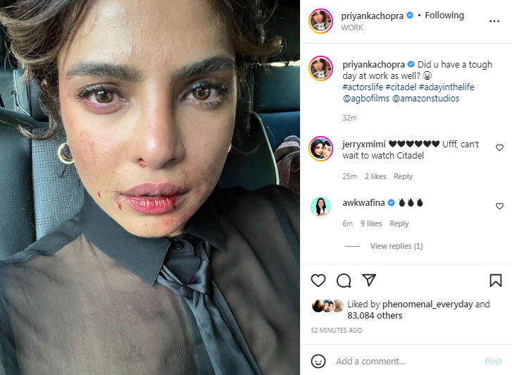 Priyanka Chopra shares pic of bruised face, leaves fans concerned - Hindustan Times