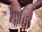 An image created during an investigation into an outbreak of monkeypox, which took place in the Democratic Republic of the Congo (DRC), 1996 to 1997, shows the hands of a patient with a rash due to monkeypox.