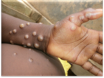 Monkeypox falls in the same category of viruses as smallpox but it is considered less severe and experts also highlighted that the chances of infection are low. Monkeypox falls in the same category of viruses as smallpox but it is considered less severe and experts also highlighted that the chances of infection are low.