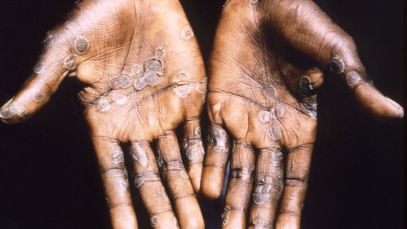 monkeypox-germany-france-and-other-nations-with-confirmed-cases-list