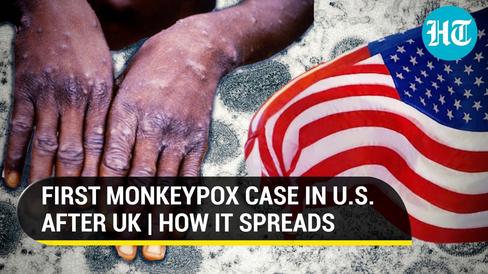 Rare Monkeypox virus spreads to US after UK & Europe Should India be