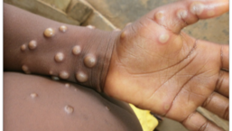 Monkeypox falls into the same category of viruses as monkeypox but it is considered less severe and experts also emphasize that the chance of infection is low.