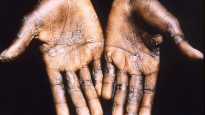 The palms of a monkeypox case patient from Lodja, a city located within the Katako-Kombe Health Zone, are seen during a health investigation in the Democratic Republic of Congo in 1997.&nbsp; (via REUTERS)
