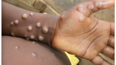 Monkeypox falls in the same category of viruses as smallpox but it is considered less severe and experts also highlighted that the chances of infection are low. (WHO)