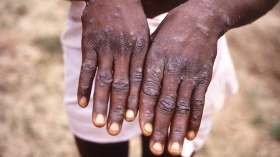 An image created during an investigation into an outbreak of monkeypox, which took place in the Democratic Republic of the Congo (DRC), 1996 to 1997, shows the hands of a patient with a rash due to monkeypox.(via REUTERS)