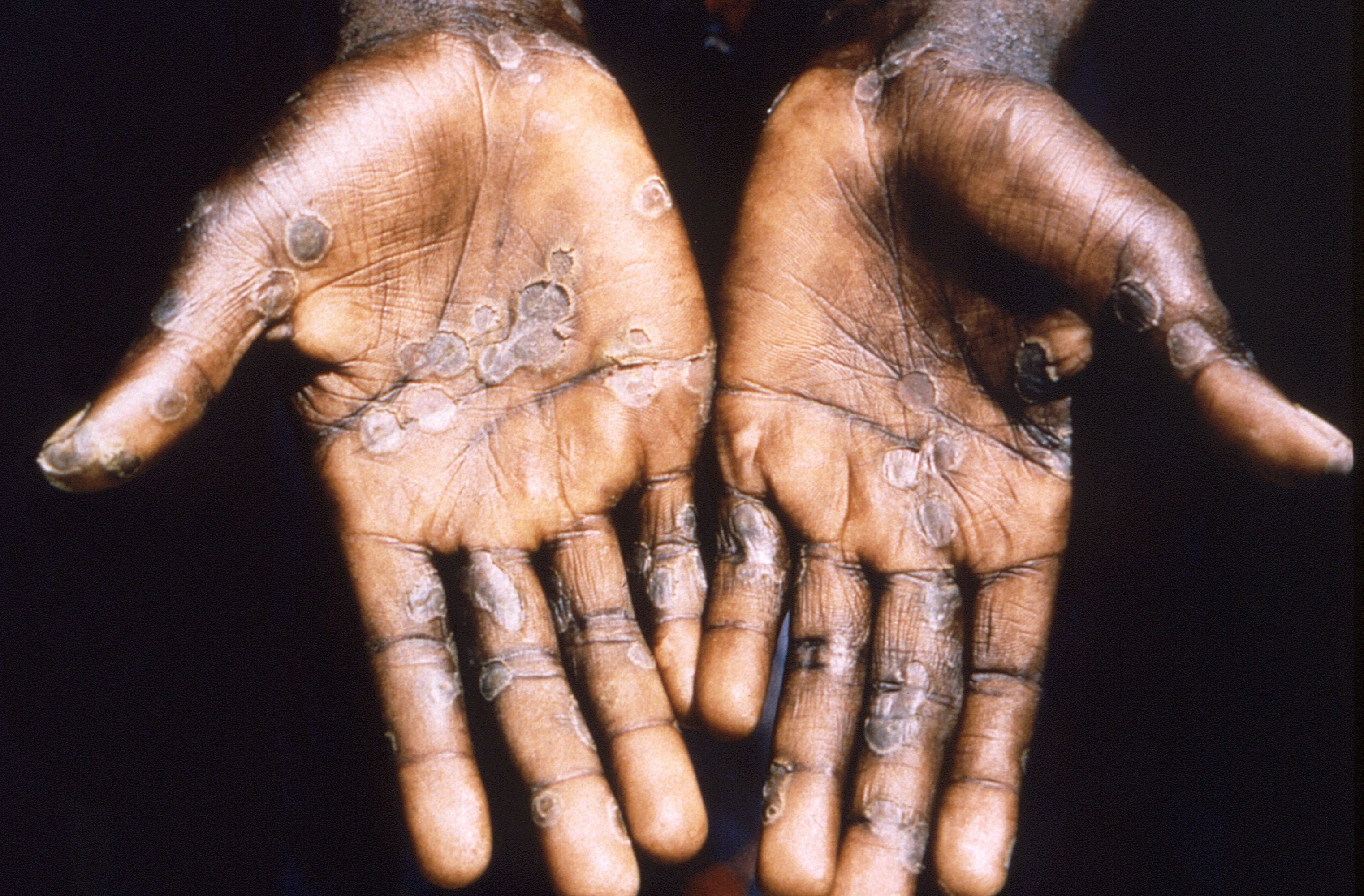 The person infected with monkeypox has to be isolated for at least 3 weeks depending on what the treating doctor feels. (via REUTERS)