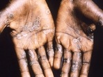 The palms of a monkeypox case patient from Lodja, a city located within the Katako-Kombe Health Zone, are seen during a health investigation in the Democratic Republic of Congo in 1997.&nbsp;(via REUTERS)