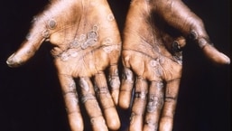 As palmas das mãos de um paciente com varíola dos macacos de Lodja, uma cidade localizada na Zona de Saúde de Katako-Kombe, são vistas durante uma investigação de saúde na República Democrática do Congo em 1997. 