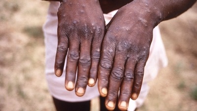An image created during an investigation into an outbreak of monkeypox in the Democratic Republic of the Congo (DRC), 1996 to 1997. CDC/Brian W.J. Mahy/Handout via REUTERS/IMAGE HAS BEEN SUPPLIED BY A THIRD PARTY. (via REUTERS)