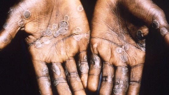 The palms of a monkeypox case patient from Lodja, a city located within the Katako-Kombe Health Zone, are seen during a health investigation in the Democratic Republic of Congo in 1997.&nbsp;(via REUTERS)