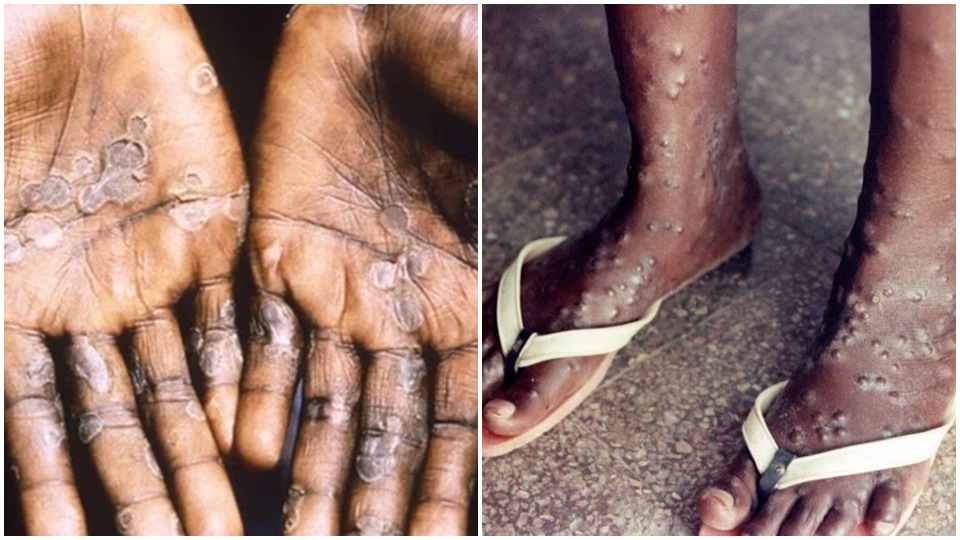 Monkeypox is similar to smallpox, but is a milder form caused by the monkeypox virus, which belongs to the same group of viruses known as orthopox virus. Monkeypox is similar to smallpox, but is a milder form caused by the monkeypox virus, which belongs to the same group of viruses known as orthopox virus.