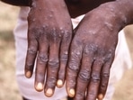 The monkeypox virus, which has been largely reported from African nations so far, is not likely to spread like Covid.(AP) The monkeypox virus, which has been largely reported from African nations so far, is not likely to spread like Covid.(AP)