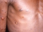 Monkeypox can also spread between people; you can catch it if you have close physical contact with an infected individual.