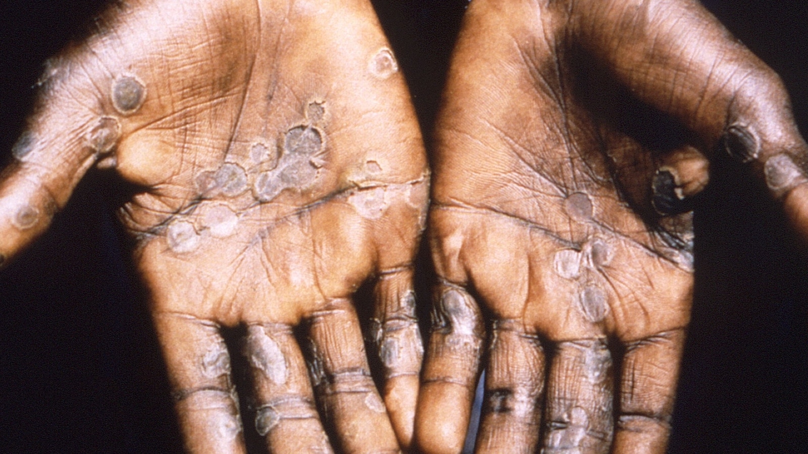 Monkeypox likely spreading among people via intimate contact