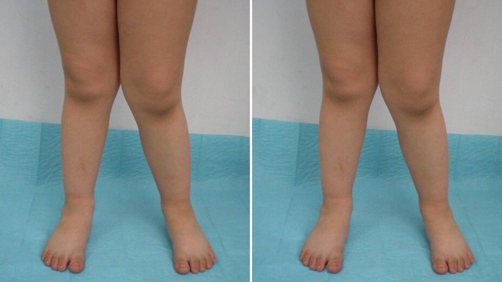 Knock Knees (Genu Valgum) (for Parents) - Nemours KidsHealth