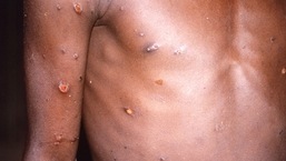 Monkeypox também pode se espalhar entre as pessoas;  você pode pegá-lo se tiver contato físico próximo com um indivíduo infectado.