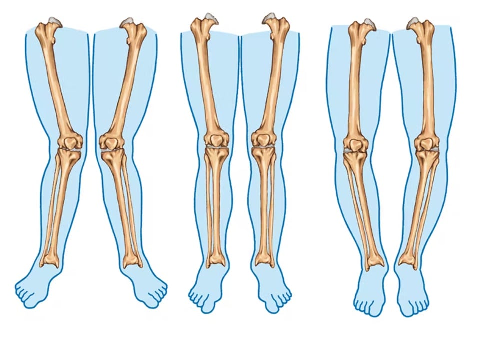 Knock Knees, Common Legs and Bow Legs (Shutterstock)