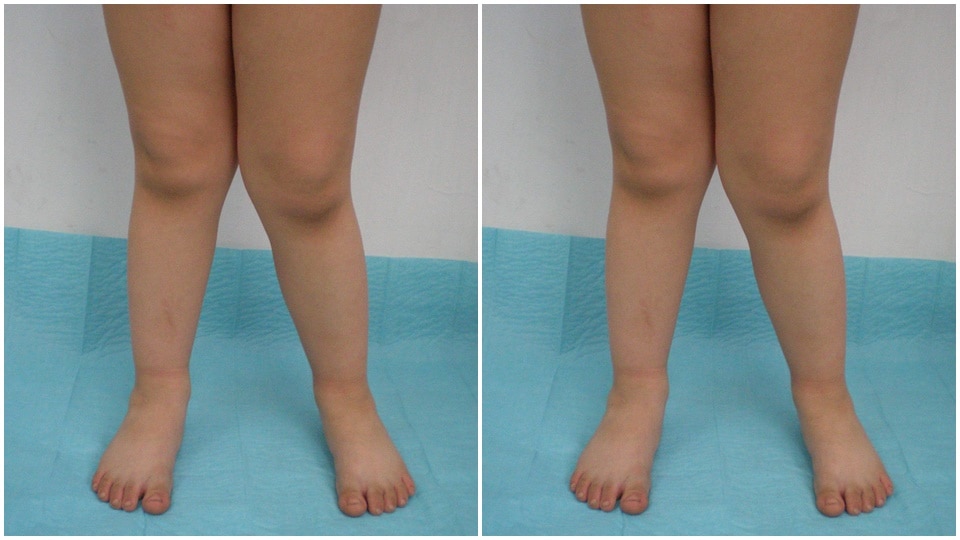 Knock knees: The condition is more common in young children in their development years (Pinterest)