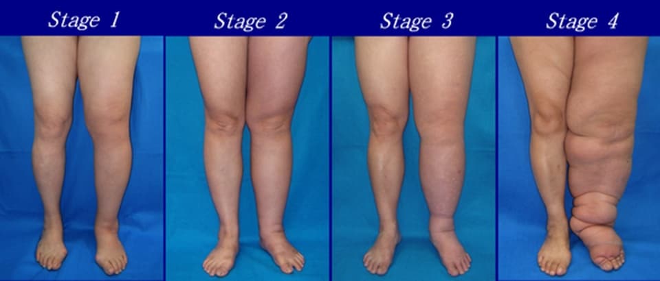Lymphedema After Breast Cancer