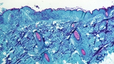 A section of skin tissue, harvested from a lesion on the skin of a monkey, that had been infected with monkeypox virus. (REUTERS)