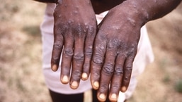 The monkeypox virus, which has been largely reported from African nations so far.