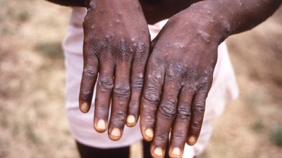 US preparing to deploy monkeypox vaccines amid more probable cases (AP)