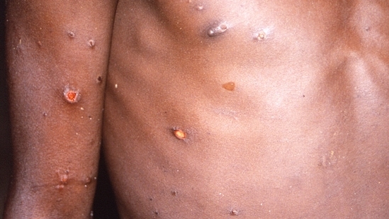 As cases of monkeypox are detected in Europe and North America, some scientists are baffled by the unusual disease's spread in developed nations.&nbsp;(AP)