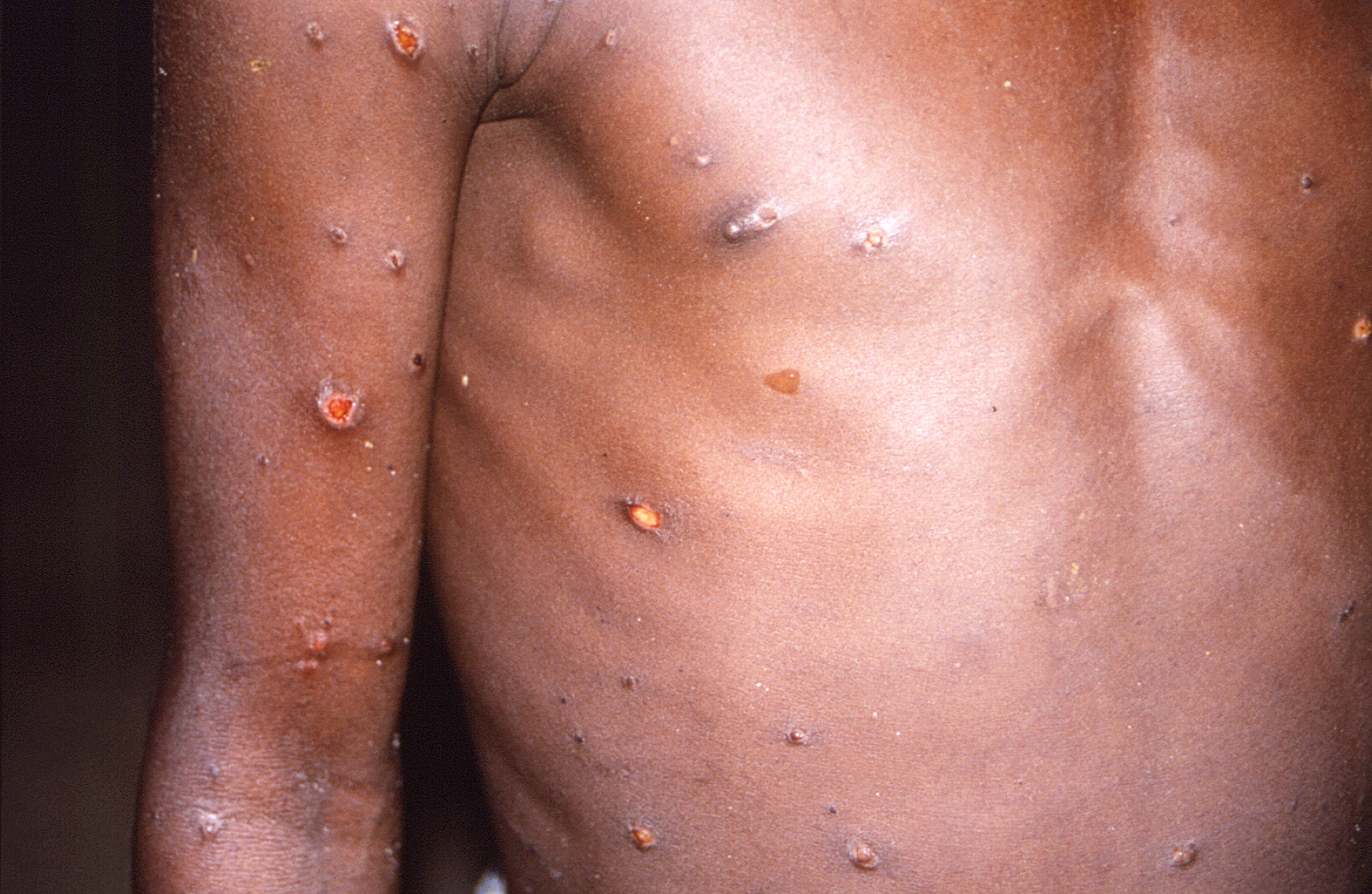 As cases of monkeypox are detected in Europe and North America, some scientists are baffled by the unusual disease's spread in developed nations. (AP) As cases of monkeypox are detected in Europe and North America, some scientists are baffled by the unusual disease's spread in developed nations. (AP)