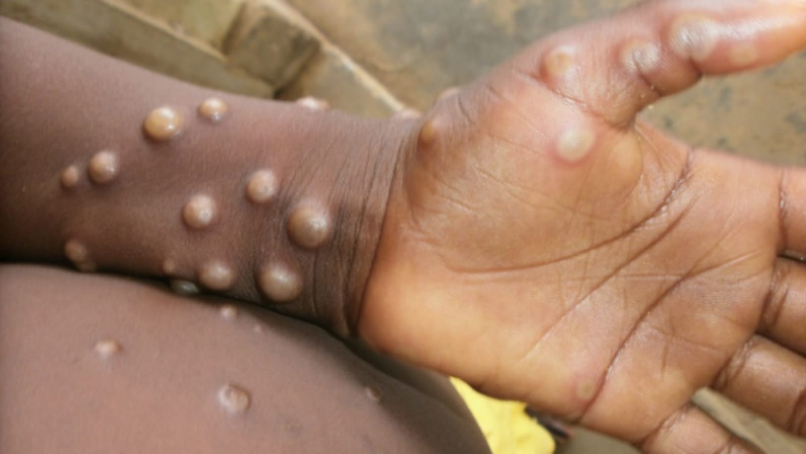 Got rashes? How do you know it's Monkeypox, not something else?