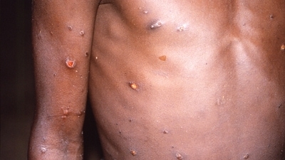 An image created during an investigation into an outbreak of monkeypox, which took place in Congo from 1996 to 1997. (REUTERS)