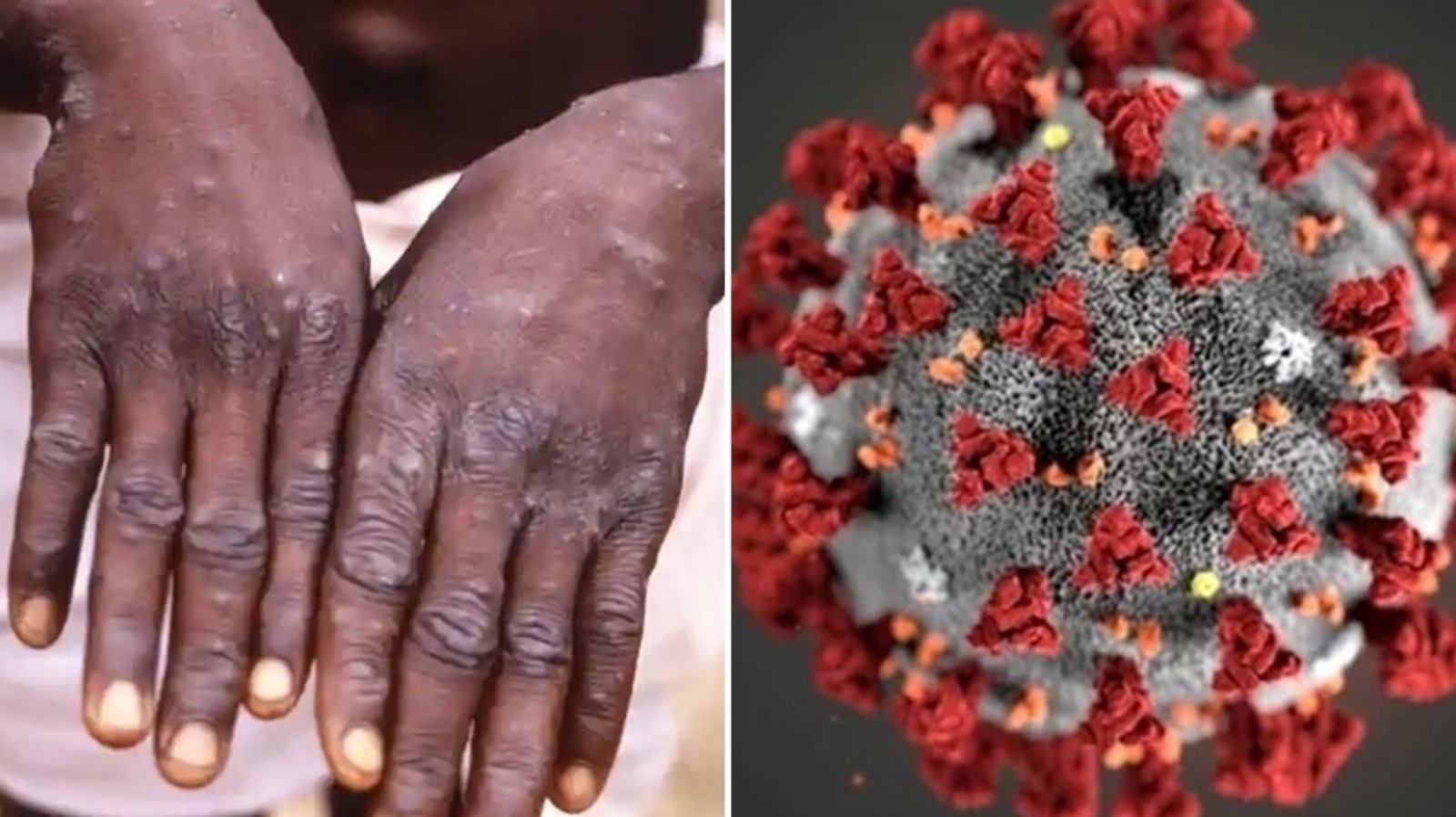 Can monkeypox and Covid-19 co-exist? Here's what an expert has to say