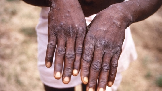 Monkeypox, a close relative of the smallpox virus, is a rare disease classified as a High Consequence Infectious Disease (HCID) by the UK Health Security Agency.(AFP)