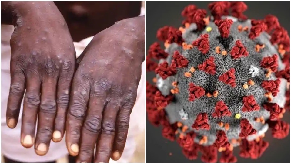 The expert added that while the monkeypox fatality is between 1-10% but with existence of covid-19 infection in the body, the fatality could go up The expert added that while the monkeypox fatality is between 1-10% but with existence of covid-19 infection in the body, the fatality could go up