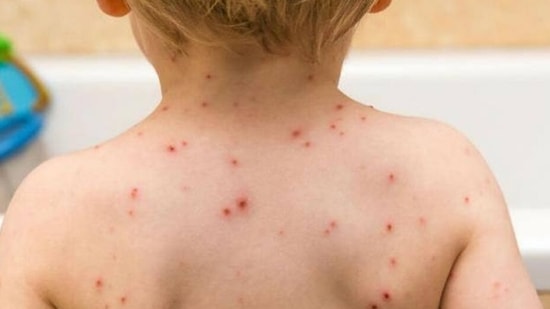 Monkeypox in kids: Symptoms to watch out for(Instagram)