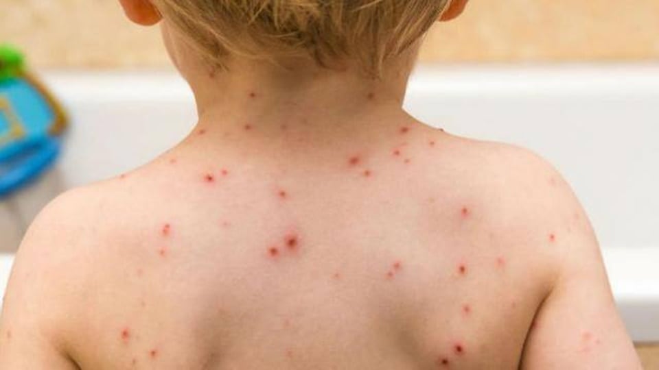Monkeypox in kids: Symptoms to watch out for (Instagram) Monkeypox in kids: Symptoms to watch out for (Instagram)