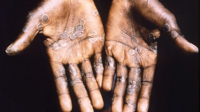 Around 200 suspected or confirmed cases of Monkeypox have been reported from 20 countries,&nbsp; (Reuters)