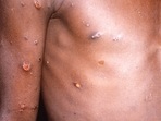 As of May 26, a total of 257 confirmed cases and 120 suspected cases of monkeypox have been reported from 23-member countries that are not endemic for the virus.