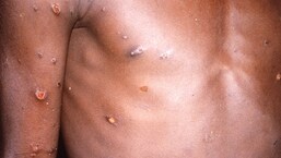 As of May 26, a total of 257 confirmed cases and 120 suspected cases of monkeypox have been reported from 23-member countries that are not endemic for the virus.