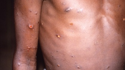 Most monkeypox patients experience only fever, body aches, chills and fatigue. (REUTERS)