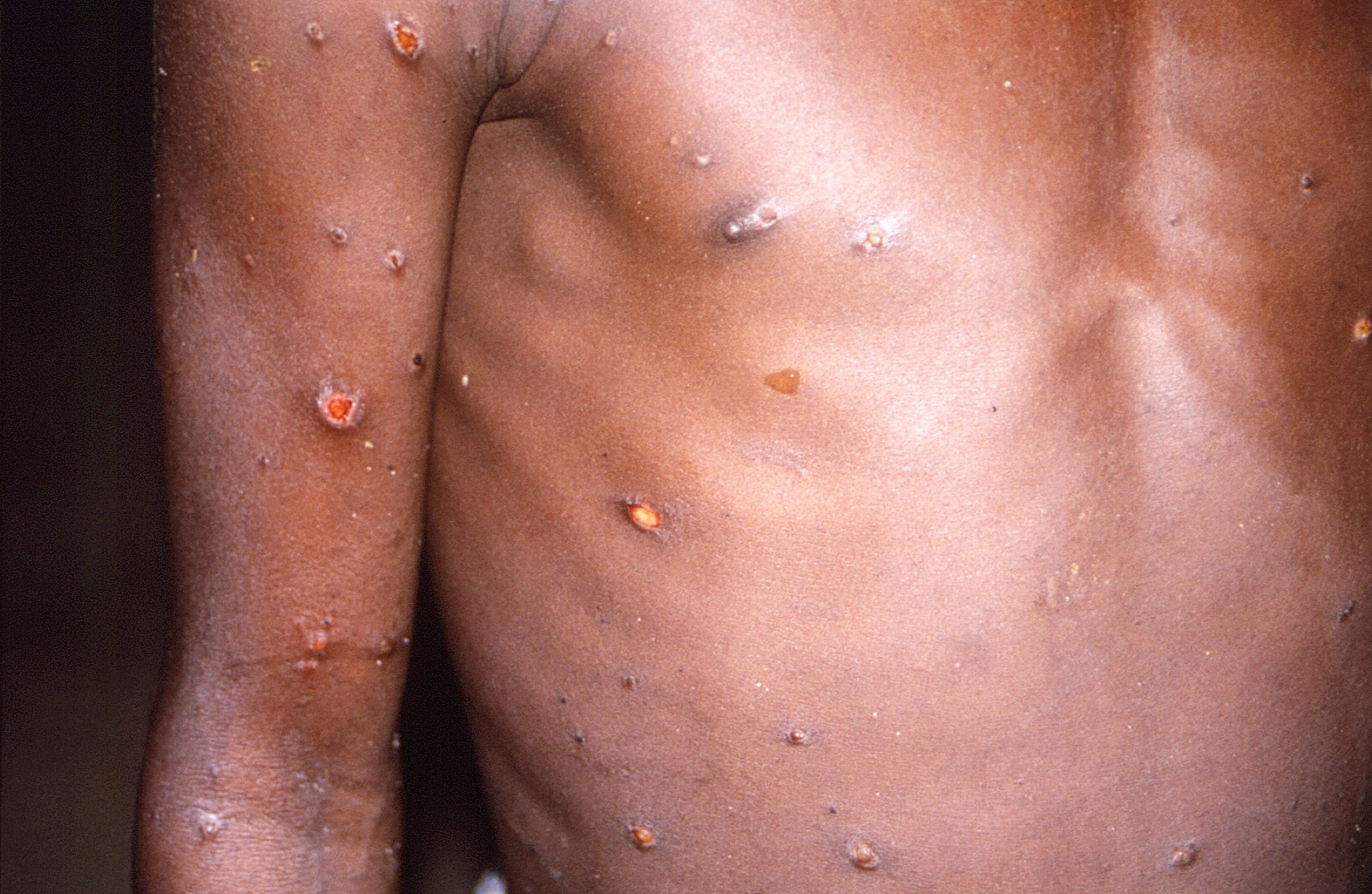 As of May 26, a total of 257 confirmed cases and 120 suspected cases of monkeypox have been reported from 23-member countries that are not endemic for the virus. (via Reuters)