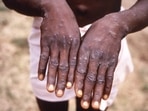UK issues guidelines on monkeypox, cases found in over 20 countries UK issues guidelines on monkeypox, cases found in over 20 countries