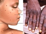 As monkeypox creates panic after being identified in several countries, it is important to know how the disease spreads. Some of its symptoms are similar to chickenpox like cold, fever, rash, body ache and fatigue. Dr. Subhash Kakkar, ENT Sr. Surgeon founder of Kakkar ENT Clinic (Karol Bagh), visiting consultant with BL Kapur hospital and Apollo Spectra lists the differences between monkeypox and chickenpox as per CDC (USA) guidelines.(Pinterest)