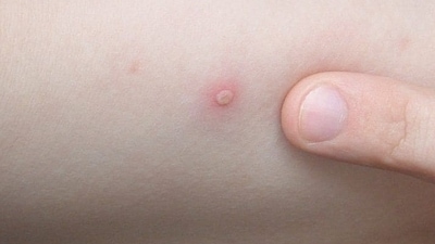 9. Symptoms: The symptoms of monkeypox and chickenpox are almost similar such as cold, fever, body ache, muscle ache, and fatigue where both lead to a widely disseminated rashes. (Pinterest) 9. Symptoms: The symptoms of monkeypox and chickenpox are almost similar such as cold, fever, body ache, muscle ache, and fatigue where both lead to a widely disseminated rashes. (Pinterest)