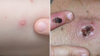 1. Virus: While monkeypox is caused by the orthopoxvirus, chickenpox is caused by the Varicella-zoster virus which is highly contagious. (Pinterest) 1. Virus: While monkeypox is caused by the orthopoxvirus, chickenpox is caused by the Varicella-zoster virus which is highly contagious. (Pinterest)