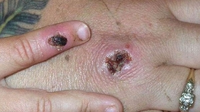 8. Treatment: In monkeypox, no specific treatment is required but a smallpox vaccine can be given to the contacts of the infected person. In chickenpox, symptomatic treatment is given but chicken-vaccine are safe and effective. (Pinterest) 8. Treatment: In monkeypox, no specific treatment is required but a smallpox vaccine can be given to the contacts of the infected person. In chickenpox, symptomatic treatment is given but chicken-vaccine are safe and effective. (Pinterest)