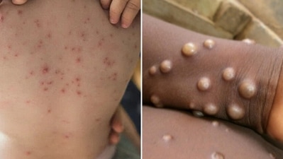 3. Fever: Monkeypox rashes appear 1 to 5 days after the fever while chickenpox rashes appear .1 to 2 days after the fever. (Pinterest, WHO) 3. Fever: Monkeypox rashes appear 1 to 5 days after the fever while chickenpox rashes appear .1 to 2 days after the fever. (Pinterest, WHO)