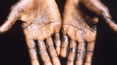 6. Transmission: Monkeypox virus enters the body via broken skin, respiratory tract, and mucus membrane while chickenpox virus enters mainly via respiratory tracts. (Reuters) 6. Transmission: Monkeypox virus enters the body via broken skin, respiratory tract, and mucus membrane while chickenpox virus enters mainly via respiratory tracts. (Reuters)