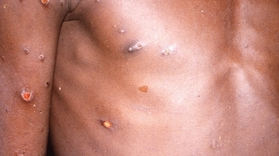 4. Swollen lymph nodes: Monkeypox lymph nodes are swollen while chickenpox lymph nodes are not swollen. (Reuters) 4. Swollen lymph nodes: Monkeypox lymph nodes are swollen while chickenpox lymph nodes are not swollen. (Reuters)