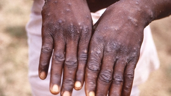 So far, no case of monkeypox has been reported in India.(AFP)